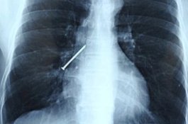 Alami Skizofrenia, Pria Ini Telan 116 Paku