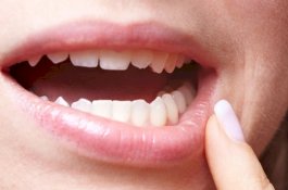 Cara Mengobati Sariawan Saat Puasa