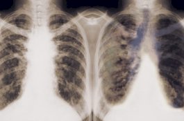 Google Ciptakan AI yang Bisa Deteksi Kanker, Lebih Akurat Dari Dokter