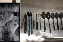 Dokter Temukan 8 Sendok dan Pisau di Perut Pria Ini