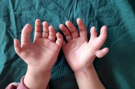 Dokter Berhasil Hilangkan Cacat Gadis yang Lahir Dengan 14 Jari