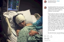 Awalnya Sakit Kepala Parah, Gadis Ini Harus Operasi 6 Kali