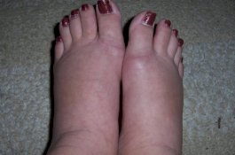 Kaki Bengkak? Atasi dengan 6 Trik Ini!