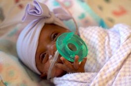 Bayi Terkecil di Dunia yang Besarnya Seukuran Apple Lahir di California