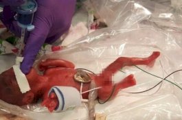 Seberat Apel, Bayi Termungil di Dunia Berhasil Bertahan Hidup