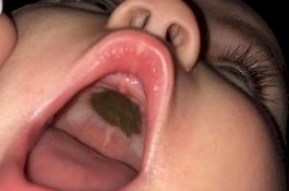 Tanda Hitam di Mulut Anaknya, Ibunya Malu Usai Tahu Penyebabnya