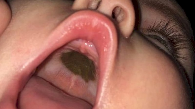 Tanda Hitam di Mulut Anaknya, Ibunya Malu Usai Tahu Penyebabnya