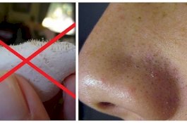 Jika Anda Coba Pembersih Kulit Alami Ini, Anda Tak Akan Beli Strip Hidung Lagi!