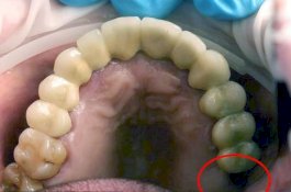 Aneh! Dokter Cabut Gigi yang Tumbuh di Testis Bocah 13 Tahun