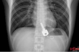 Terlalu Mabuk, Pria ini Tidak Sadar Telan Kunci Rumahnya