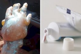 Ini Alasannya Mengapa Anda Tak Boleh Gunakan Pasta Gigi pada Luka Bakar