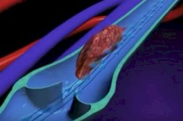 Ini 9 Tanda Anda Memiliki Gumpalan Darah