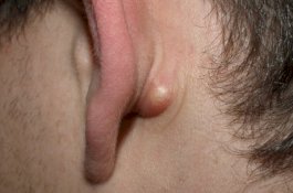 Apakah Anda Miliki Benjolan Kecil aneh di Belakang Telinga? Ini artinya!