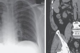 Keluhkan Batuk, Pria 66 Tahun Ini Organnya Salah Tempat