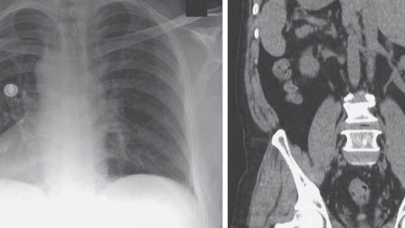 Keluhkan Batuk, Pria 66 Tahun Ini Organnya Salah Tempat