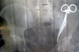 Penjepit Bedah Bersarang di Perut Wanita ini Selama 23 Tahun