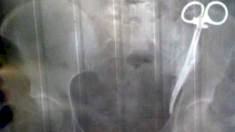 Gunting bedah bersarang di put pasen
