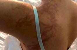 Terima Luka Mengerikan, Wanita Ini Selamat Usai Disengat Ubur-ubur Mematikan