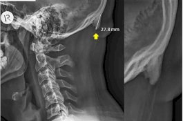 Karena Penggunaan Smartphone, Tanduk Bisa Tumbuh di Bawah Tengkorak