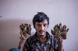 'Manusia Pohon' Asal Bangladesh Minta Diamputasi untuk Atasi Rasa Sakit