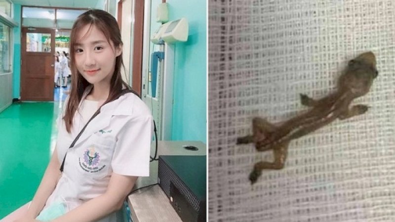 dr Varanya Nhanthavee menemukan cicak di dalam telinga pasiennya.