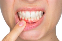 Gusi Bengkak: Penyebab, Gejala dan Cara Mengobatinya