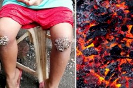 Lupa Tas di Sekolah, Bocah Dipaksa Ibu Berlutut di Bara Api