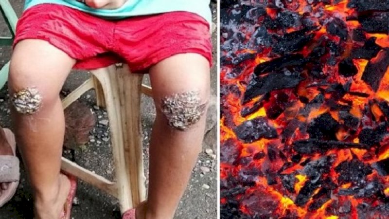 Korban mengalami luka bakar di bagian lutut.