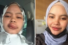 Gigitan Serangga Bikin Bibir Wanita Ini Seseksi Angelina Jolie, Warganet Tertawa