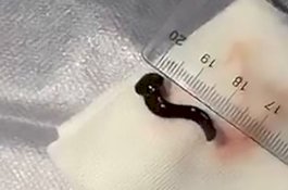 Awalnya Batuk Darah, Ternyata Ada Lintah di Tenggorokan Wanita Ini