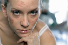 Mengenal Jerawat Dewasa dan Bagaimana Mengatasinya