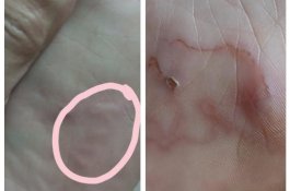 Mengerikan, Wanita Ini Alami Infeksi Cacing Setelah Liburan