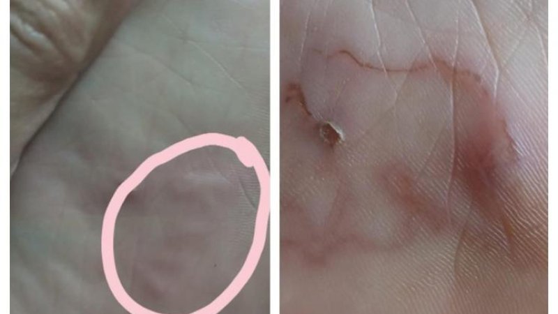 Seorang wanita kena infeksi cacing di kakinya. (Facebook.com/Nurul Ezzatul)
