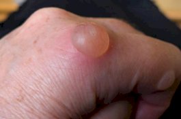 Tips Mengobati Kulit yang Melepuh