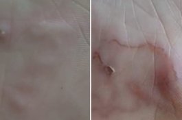 Usai Liburan, Gadis Malaysia Ini Temukan Parasit di Kakinya