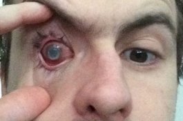 Pria ini Buta Sebelah Akibat Kebiasaan Mandi Pakai Lensa Kontak