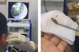 Kupu-kupu Terjebak di Telinga Seorang Pria Selama 3 Hari