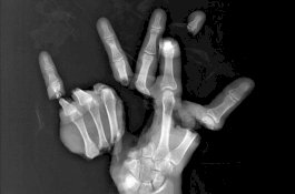 Dokter Satukan Kembali Tangan Pasien yang Hancur Berantakan