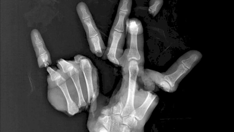 Dokter Satukan Kembali Tangan Pasien yang Hancur Berantakan