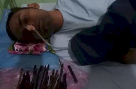 Dokter Keluarkan 33 Benda Aneh dari Perut Pasien, Termasuk Pisau