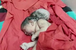 Kondisi Medis Langka, Bayi Perempuan Ini Lahir dengan Tiga Kepala