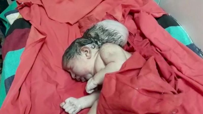 Kondisi Medis Langka, Bayi Perempuan Ini Lahir dengan Tiga Kepala