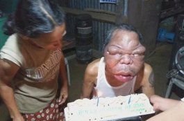 Awalnya Kena Sinusitis, Kepala Pria Ini Perlahan Membengkak