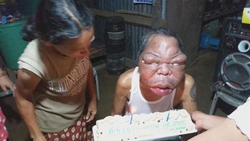 Awalnya Kena Sinusitis, Kepala Pria Ini Perlahan Membengkak
