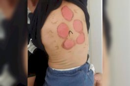 92 Anak Dapat Luka Bakar Usai Terapi Pengobatan