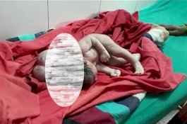 Bayi di India Lahir Dengan Tiga Kepala