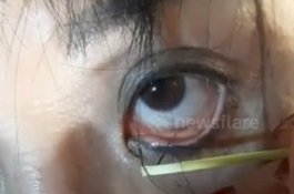 Ngeri! Belasan Cacing Hidup Ditarik dari Mata Pasien Wanita