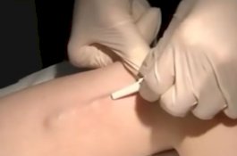 Implan Kontrasepsi Ditanam di Lengan, Ternyata Bergeser ke Paru-paru Wanita Ini