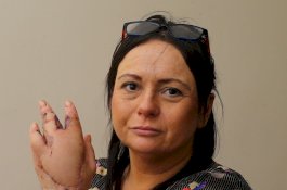 Awalnya Dicakar Kucing, Wanita ini Nyaris Mati Karena Bakteri