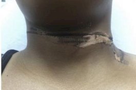 Isi Daya Smartphone saat Tidur, Wanita Ini Dapati Lehernya dengan Luka Bakar